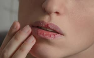 Cómo evitar labios agrietados durante el invierno