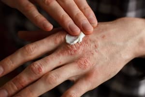 Día Mundial de la Psoriasis: romper el estigma y sanar
