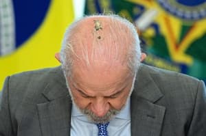 Lula inició radioterapia preventiva tras cáncer de piel