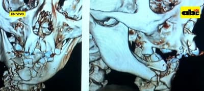 Cebollón estalló en la boca de un hombre y ahora necesita reconstrucción
