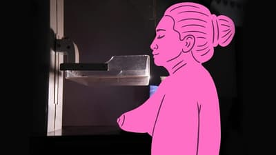 Alarma en Paraguay: 10 mujeres mueren cada semana por cáncer de mama