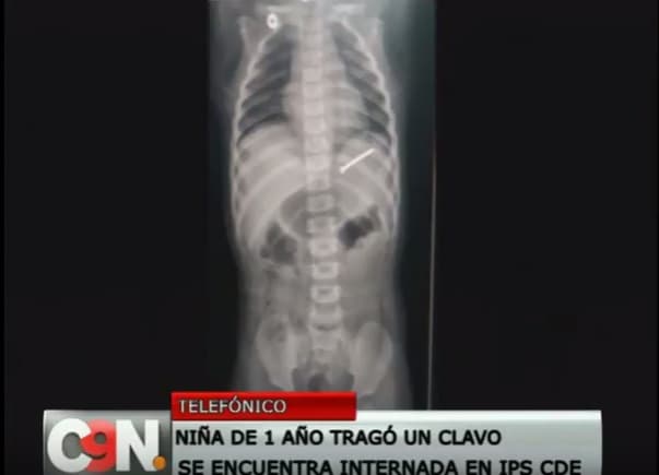 Bebé de 1 año tragó un clavo