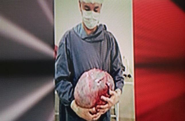 Extirpan tumor de 11 kilos de una mujer