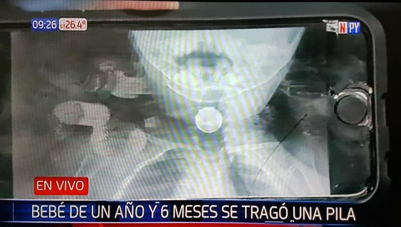Bebé tragó una pila y se encuentra grave