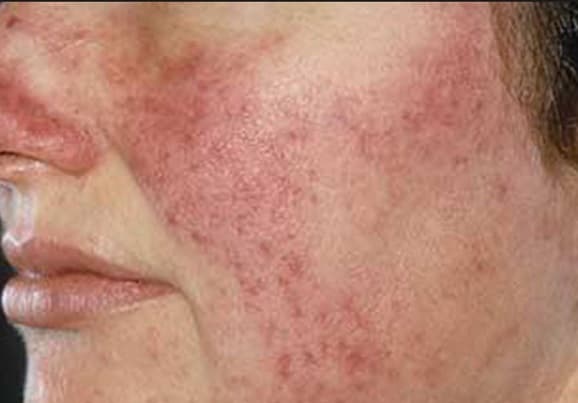 La rosácea, un mal cutáneo que predomina en mujeres pero puede tratarse