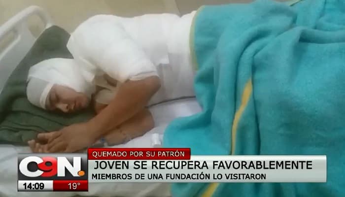 Joven quemado con agua caliente se recupera