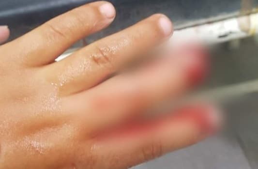 Niño pierde dedos a causa de "cebollón"