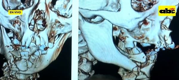 Cebollón estalló en la boca de un hombre y ahora necesita reconstrucción