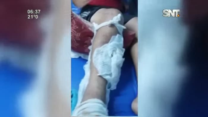 Hombre accidentado vuelve a fracturarse la pierna ante desidia del IPS