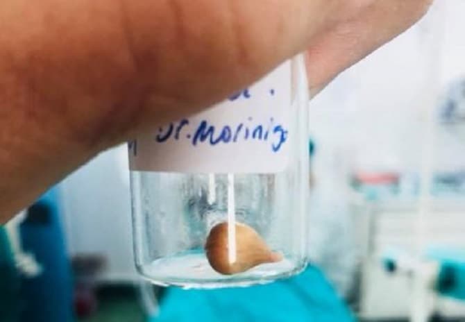 Semilla de mandarina casi causa muerte de niño por asfixia