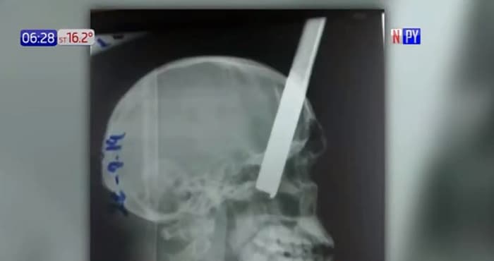 Guardia termina con una varilla en el cráneo tras discusión