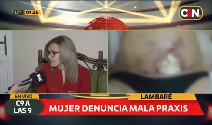 Mujer narra padecimiento a causa de cirugía estética fallida