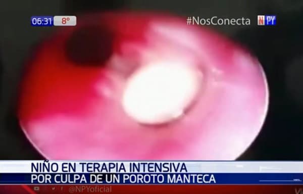 Niño se encuentra en terapia intensiva a causa de un poroto manteca