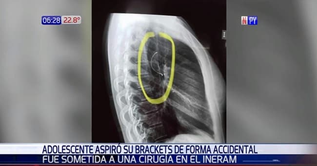 Someten a intervención a adolescente que tragó parte de su frenillo