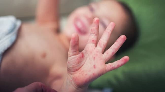 Confirman primer caso de sarampión en Central