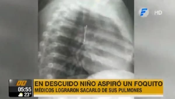 Extraen foco de juguete de pulmón de niño