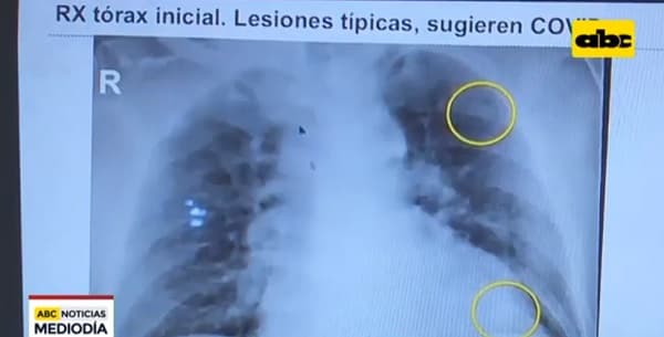 Especialistas explican cómo ataca el Covid-19 a los pulmones