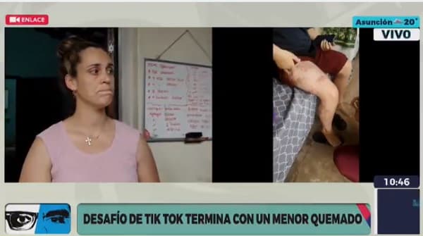 Niño sufrió quemaduras en desafío de TikTok y ahora necesita ayuda