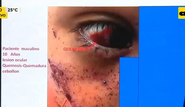 Tendrán que rehacer un pulgar a niño que sufrió explosión de 12x1