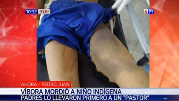 Niño en grave estado tras ser mordido por una víbora