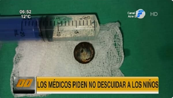 Intervienen a tres niños por haber tragado objetos y maíz