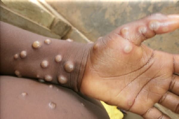 Confirman segundo caso de viruela del mono en Paraguay