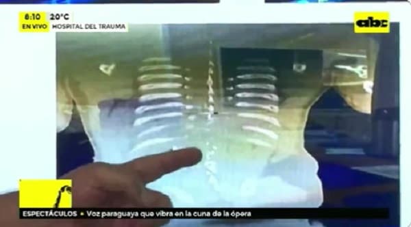 Nativo herido quedará paralizado del ombligo para abajo