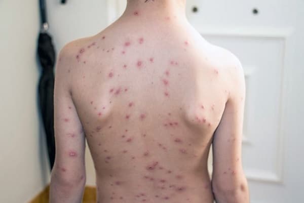 Brote de varicela en Encarnación: 44 estudiantes aislados