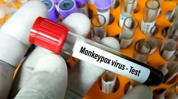 Confirman primer caso de viruela del mono en Foz de Iguazú