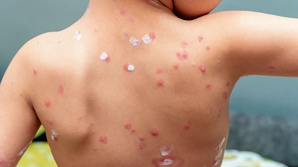 Salud reporta aumento de casos de varicela