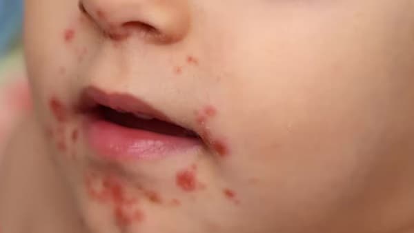 Incremento de casos de la enfermedad de “Boca, Manos y Pies” genera preocupación