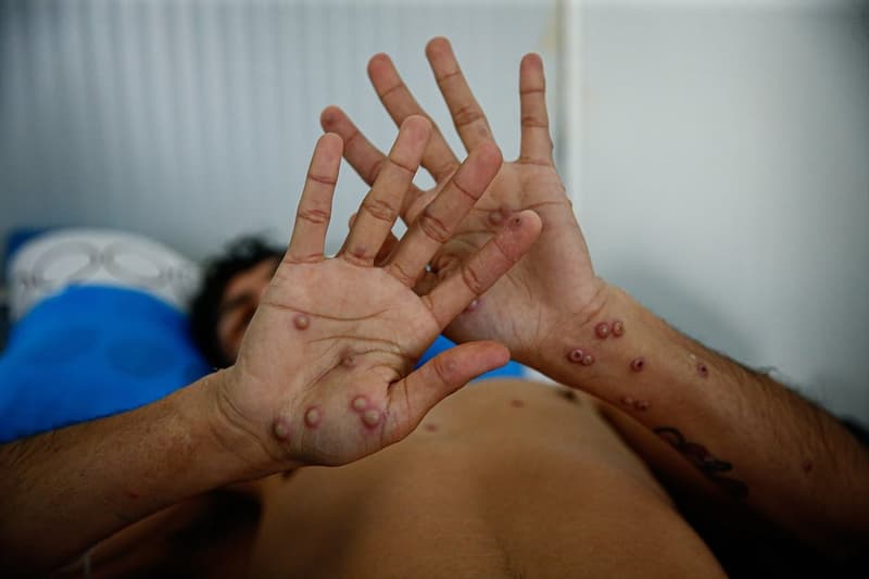 África en alerta: OMS declara emergencia por viruela del mono