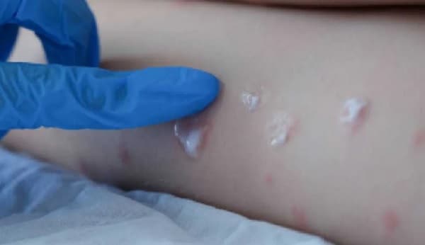 Argentina confirma primer caso autóctono de viruela del mono