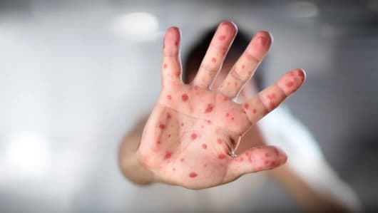 Posible caso de viruela del mono detectado en Encarnación, Itapúa