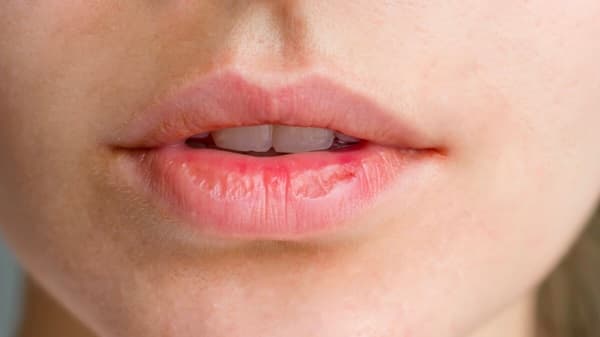 Cómo prevenir los labios cortados y mantenerlos hidratados