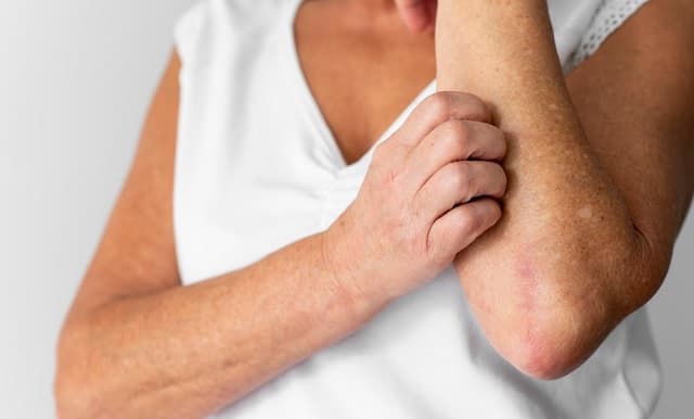 Día Mundial de la Psoriasis: avances y esperanza para pacientes