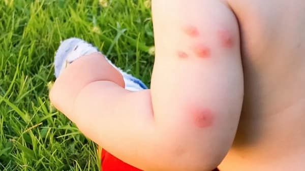 Consejos para evitar picaduras de mosquitos en niños