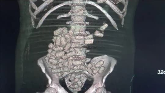 Hallan cápsulas de droga en hombre desvanecido