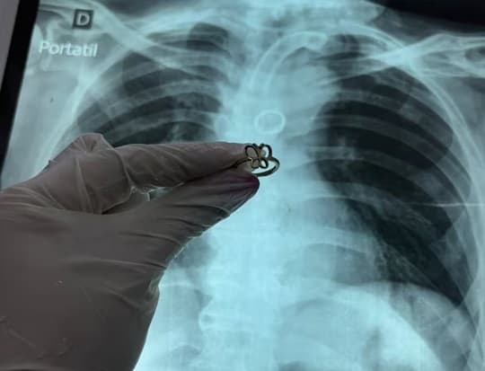 Ineram: extraen anillo de oro del pulmón de paciente
