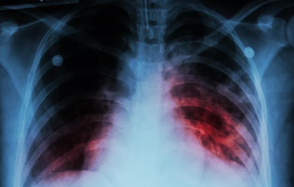 Día Mundial alerta sobre impacto de la tuberculosis